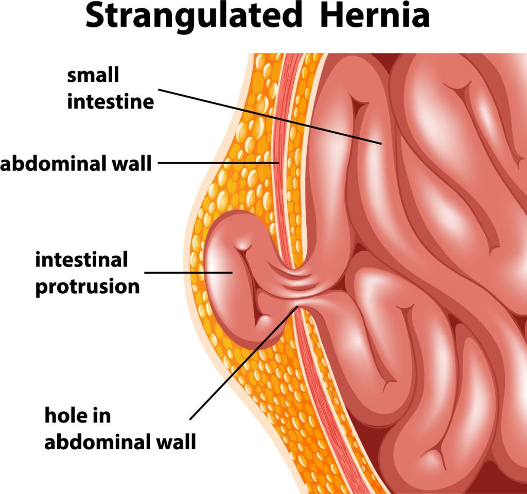 Strangulated Hernia