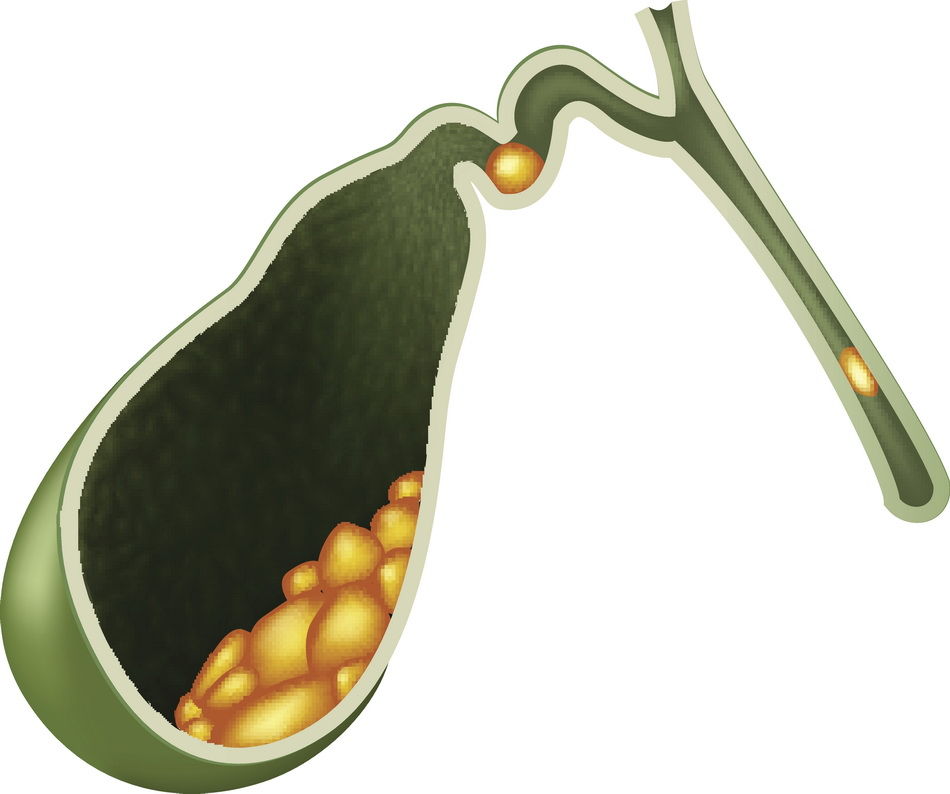 Gallbladder surgery by Dr Palan