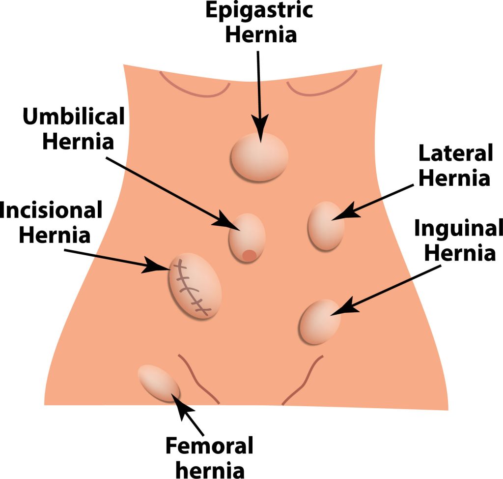 what is a hernia